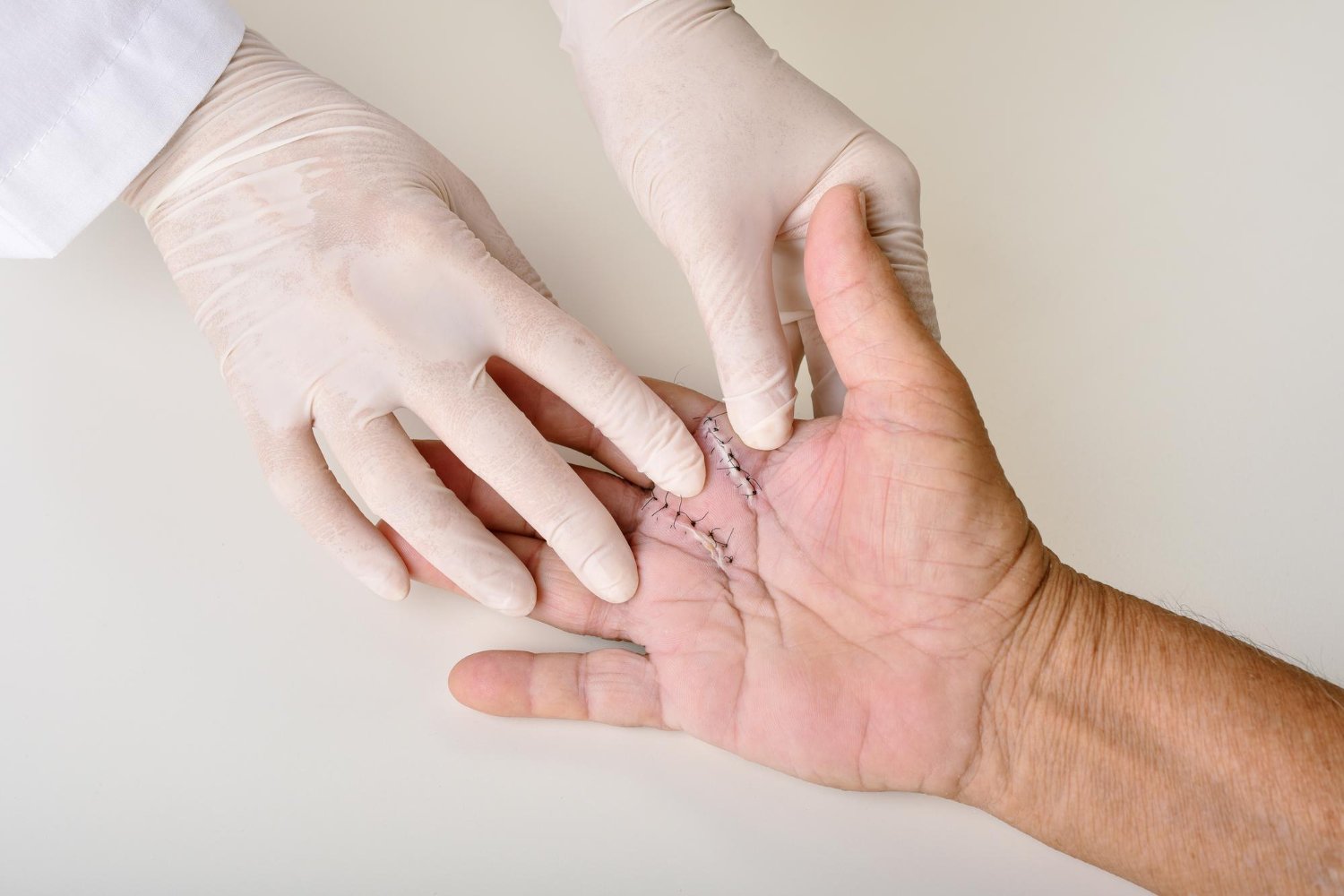 Hand and Finger Reconstructive Surgery